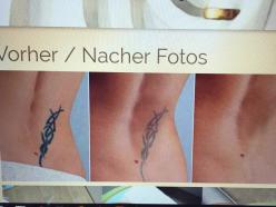 Vorher / Nachher Fotos Tattooentfernung