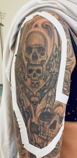 Tattoo-Teil-Entfernung Oberarm